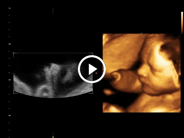 4d ultrahang videófelvétel